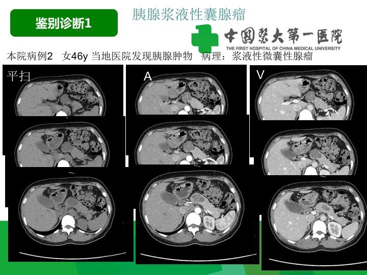 【病例】胰腺实性假乳头状瘤1例CT及MR影像-24