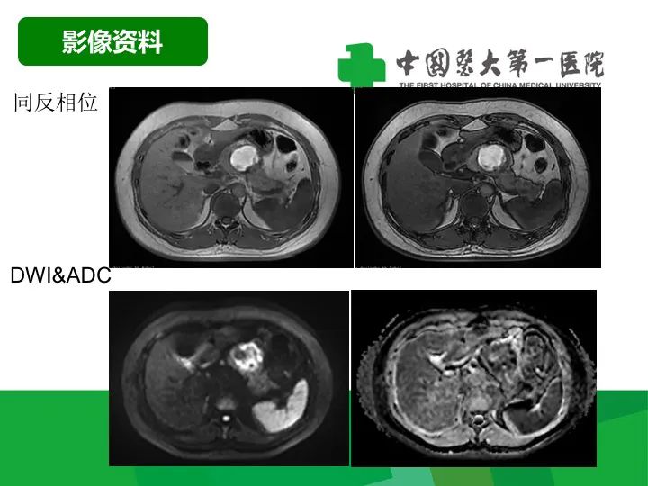 【病例】胰腺实性假乳头状瘤1例CT及MR影像-5