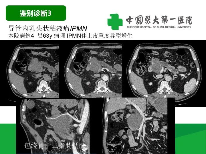 【病例】胰腺实性假乳头状瘤1例CT及MR影像-35