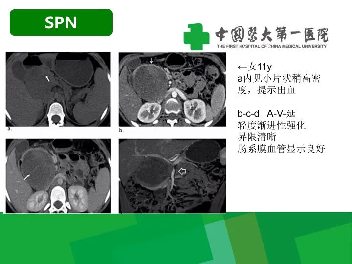 【病例】胰腺实性假乳头状瘤1例CT及MR影像-14