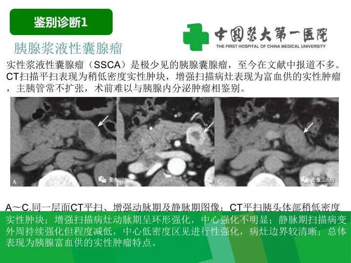 【病例】胰腺实性假乳头状瘤1例CT及MR影像-27