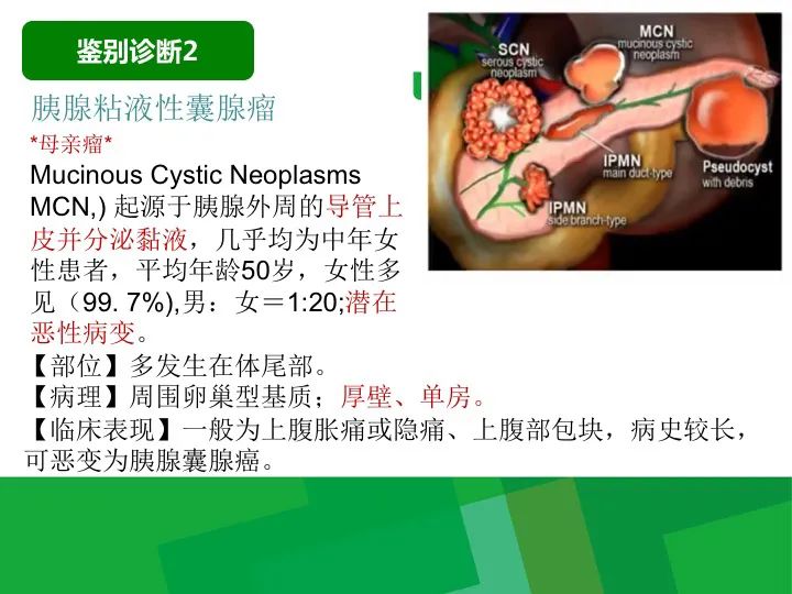 【病例】胰腺实性假乳头状瘤1例CT及MR影像-28