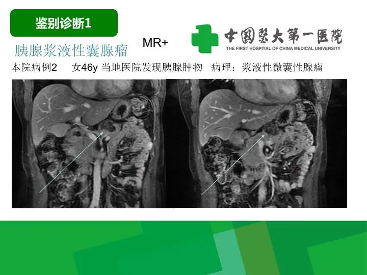 【病例】胰腺实性假乳头状瘤1例CT及MR影像-26