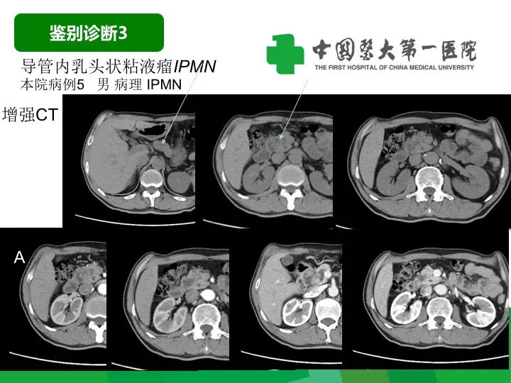 【病例】胰腺实性假乳头状瘤1例CT及MR影像-38