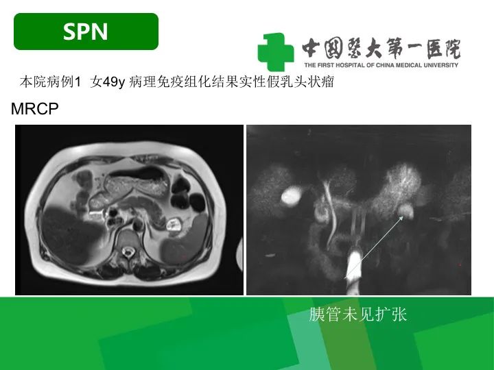 【病例】胰腺实性假乳头状瘤1例CT及MR影像-16