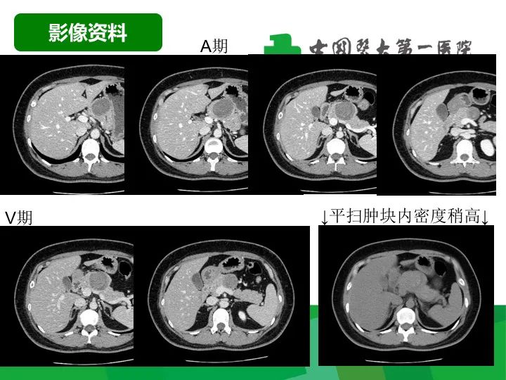 【病例】胰腺实性假乳头状瘤1例CT及MR影像-3