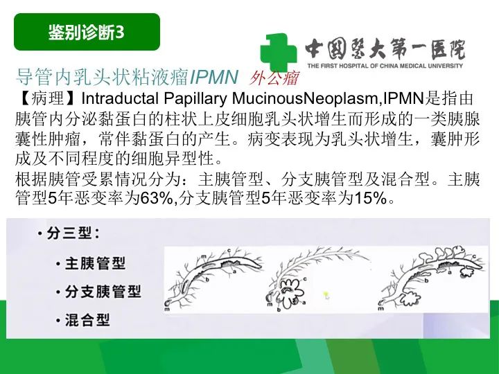 【病例】胰腺实性假乳头状瘤1例CT及MR影像-32