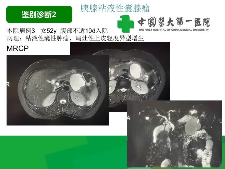 【病例】胰腺实性假乳头状瘤1例CT及MR影像-31