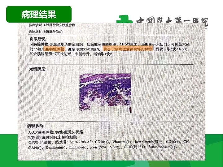 【病例】胰腺实性假乳头状瘤1例CT及MR影像-9