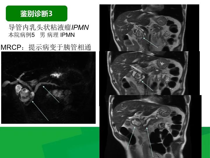 【病例】胰腺实性假乳头状瘤1例CT及MR影像-39