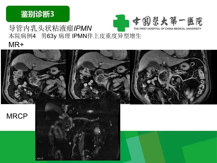 【病例】胰腺实性假乳头状瘤1例CT及MR影像-37