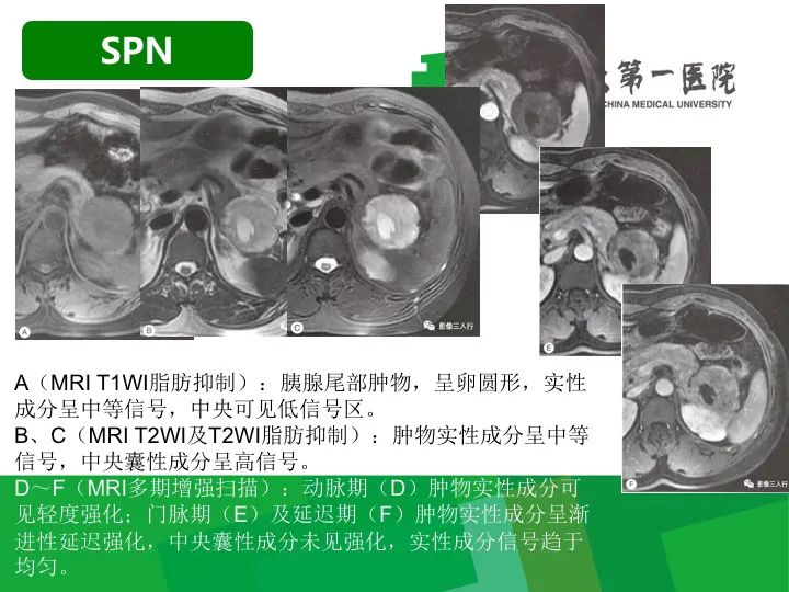 【病例】胰腺实性假乳头状瘤1例CT及MR影像-17