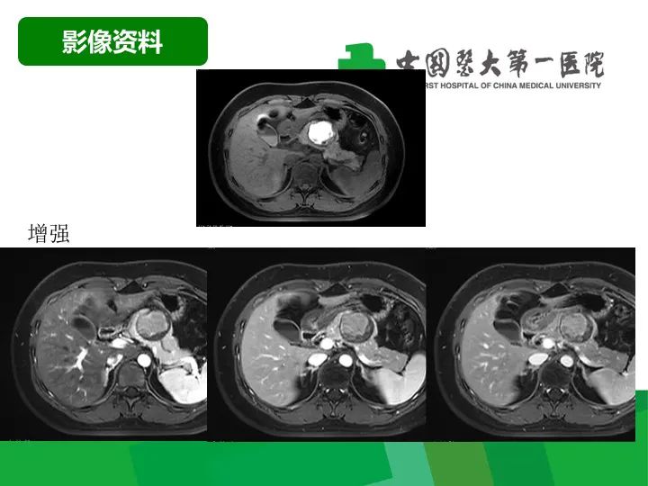 【病例】胰腺实性假乳头状瘤1例CT及MR影像-6