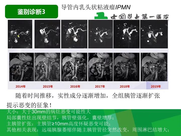 【病例】胰腺实性假乳头状瘤1例CT及MR影像-40