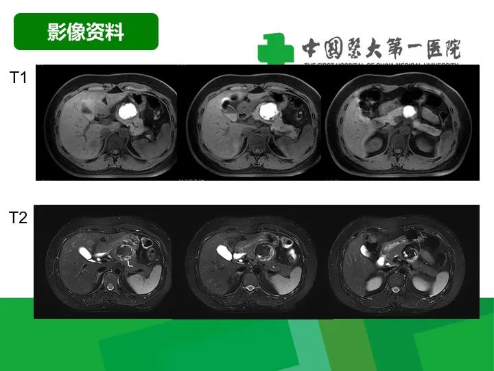 【病例】胰腺实性假乳头状瘤1例CT及MR影像-4