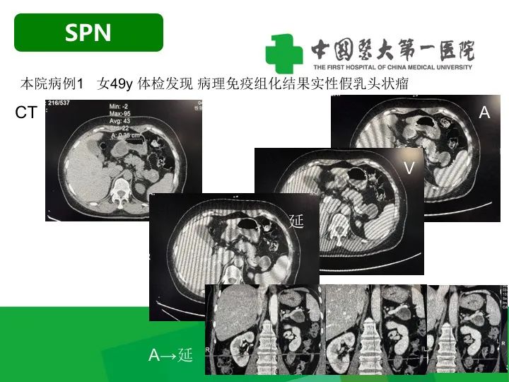 【病例】胰腺实性假乳头状瘤1例CT及MR影像-15