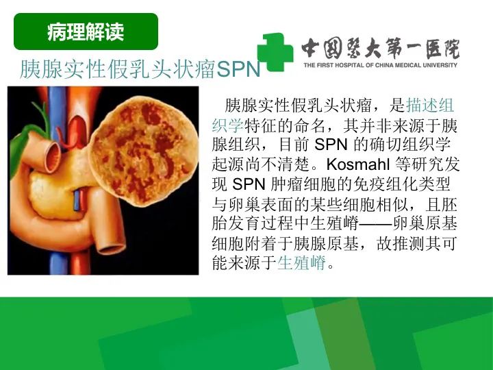 【病例】胰腺实性假乳头状瘤1例CT及MR影像-11