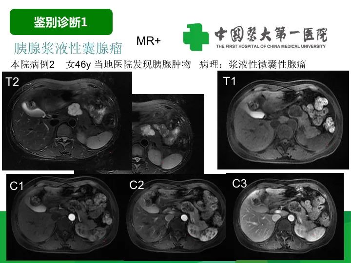 【病例】胰腺实性假乳头状瘤1例CT及MR影像-25