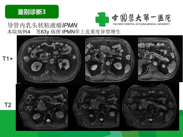【病例】胰腺实性假乳头状瘤1例CT及MR影像-36