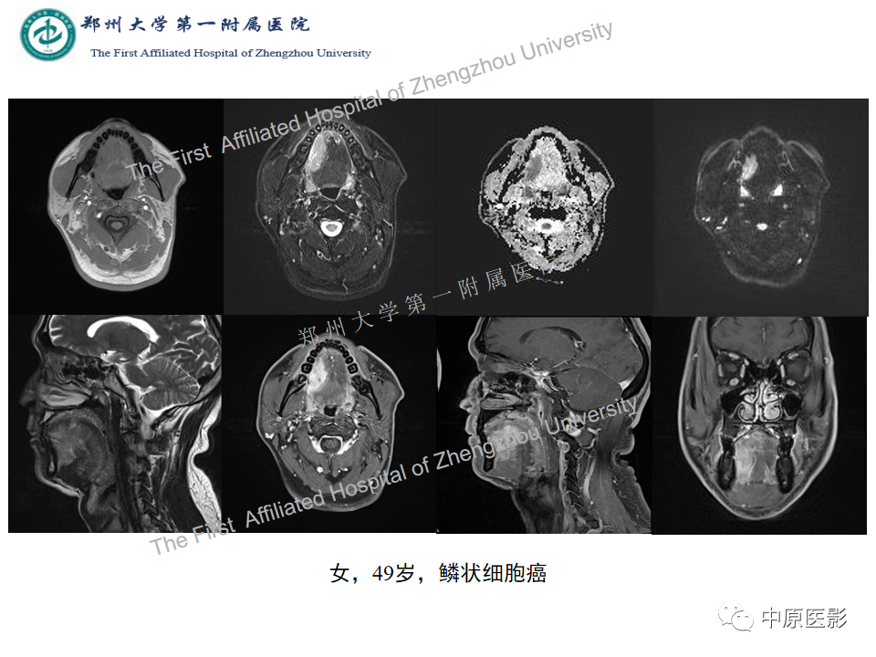 【病例】舌神经鞘瘤1例MR影像-18
