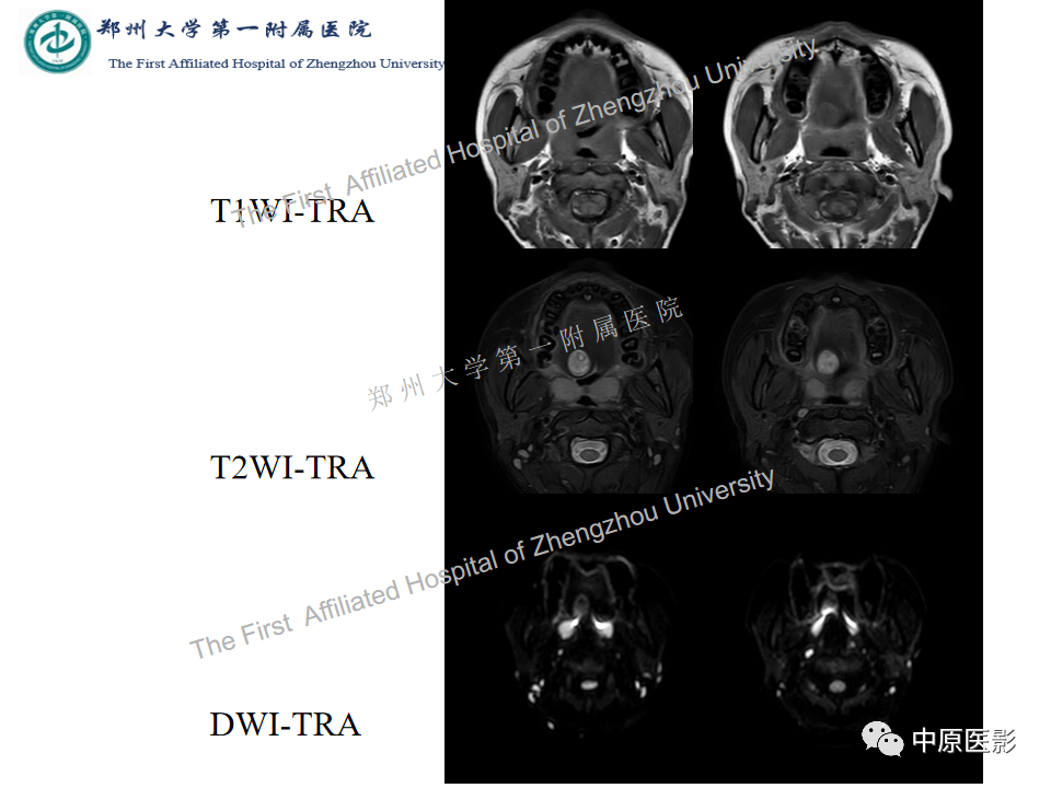 【病例】舌神经鞘瘤1例MR影像-3
