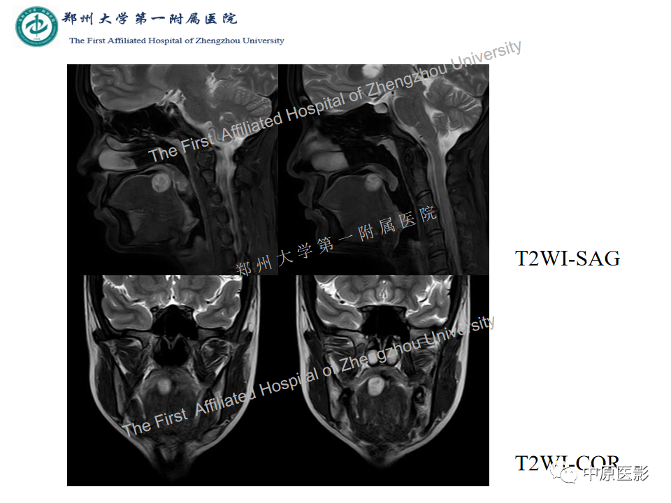 【病例】舌神经鞘瘤1例MR影像-4