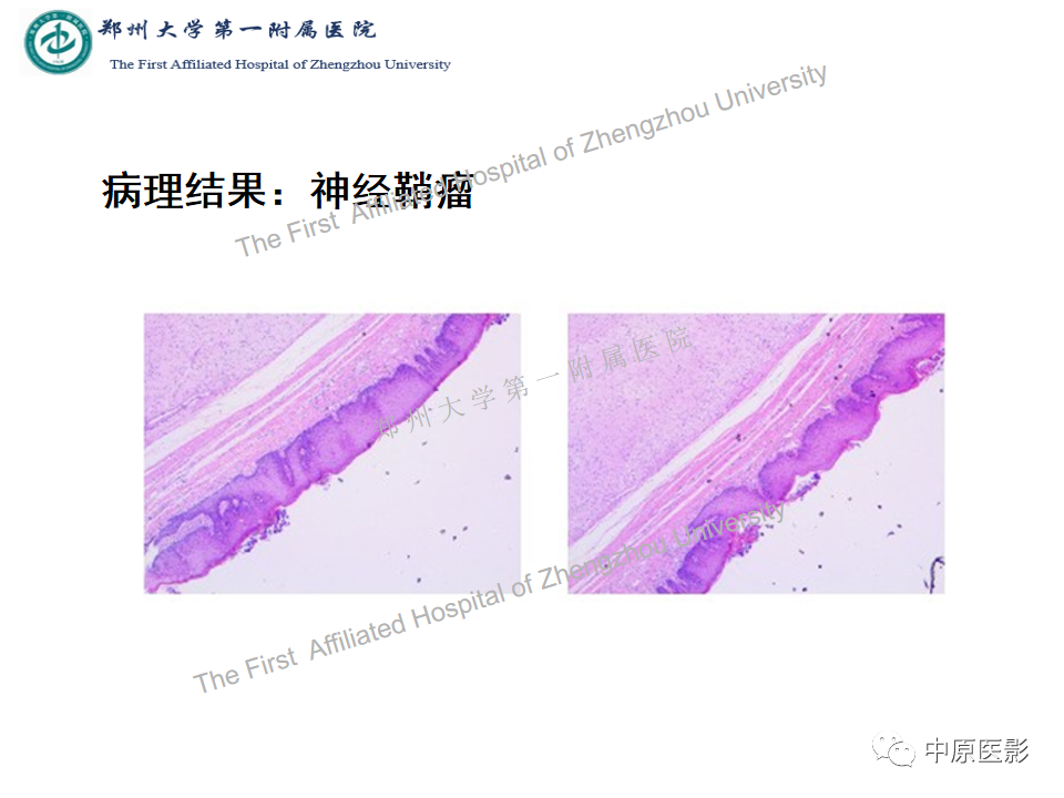 【病例】舌神经鞘瘤1例MR影像-9