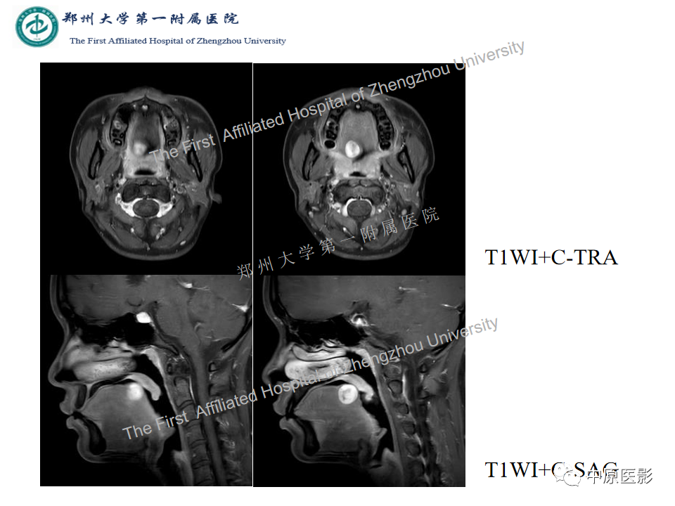【病例】舌神经鞘瘤1例MR影像-5