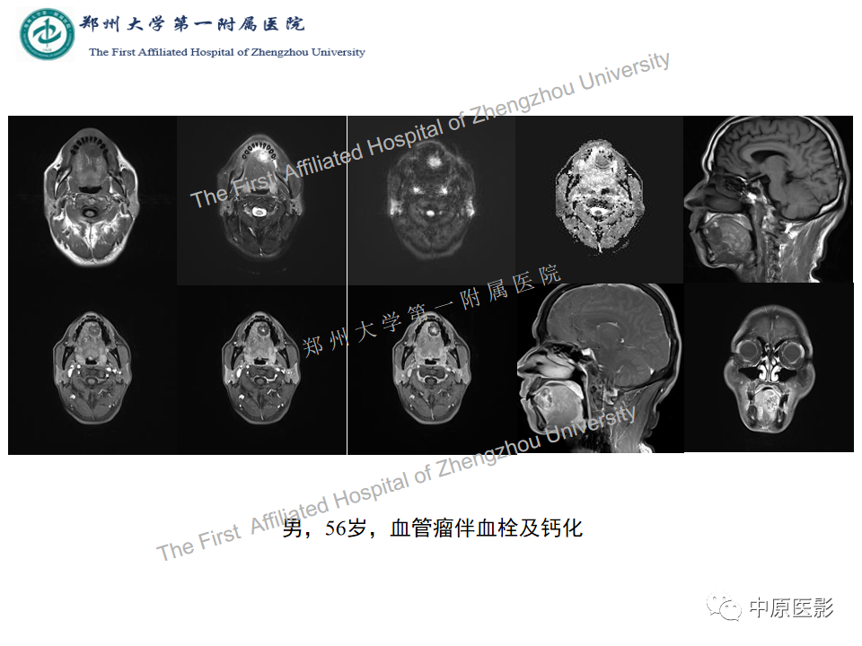 【病例】舌神经鞘瘤1例MR影像-14
