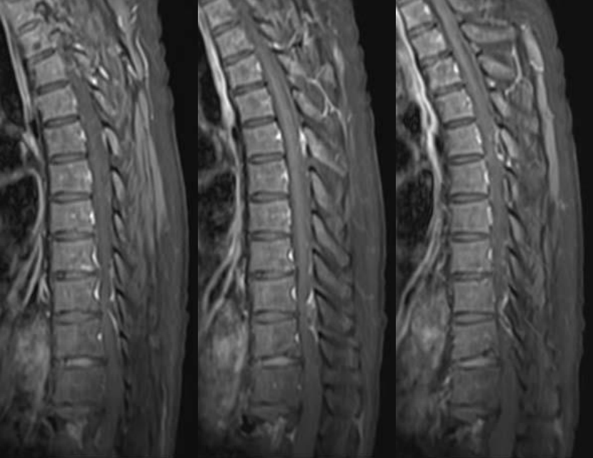 【病例】痛风常见，您见过罕见的椎管内痛风结石吗？-6