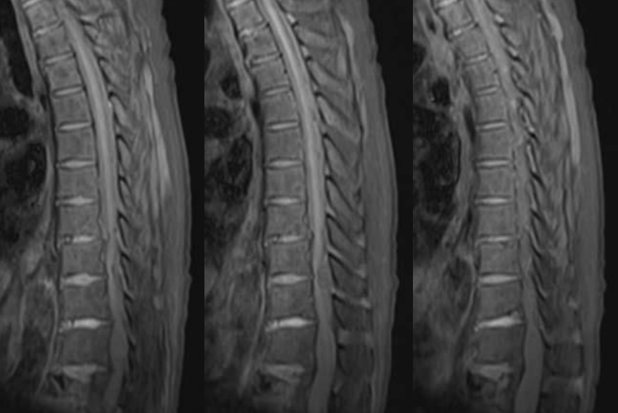 【病例】痛风常见，您见过罕见的椎管内痛风结石吗？-5