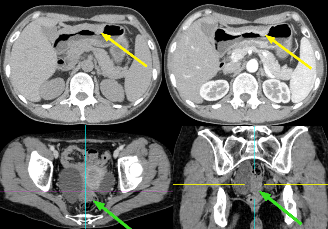 【病例】盆腔肿块，需要考虑到这个来源…-1