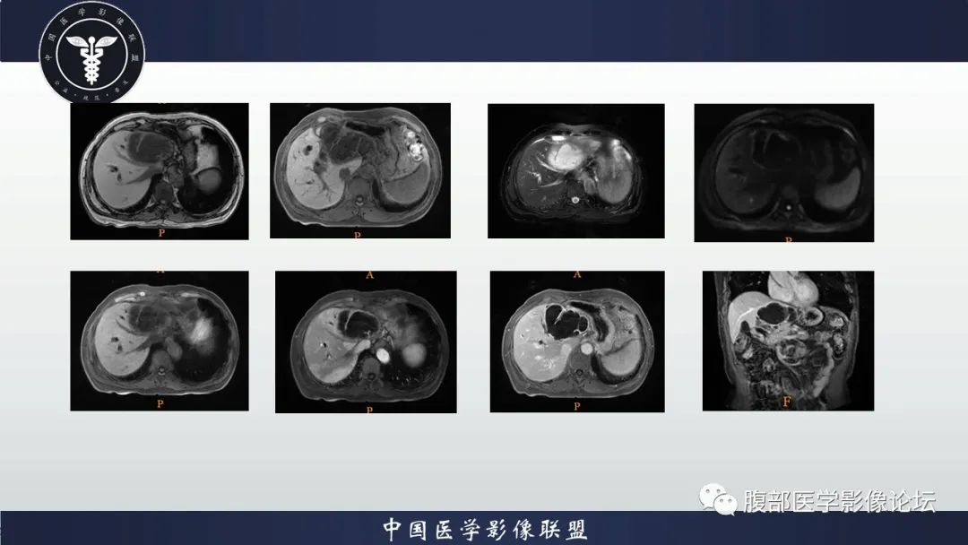 【病例】肝脏交界性粘液性囊腺瘤1例CT及MR影像-4