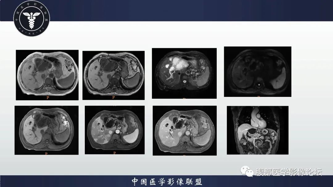 【病例】肝脏交界性粘液性囊腺瘤1例CT及MR影像-5