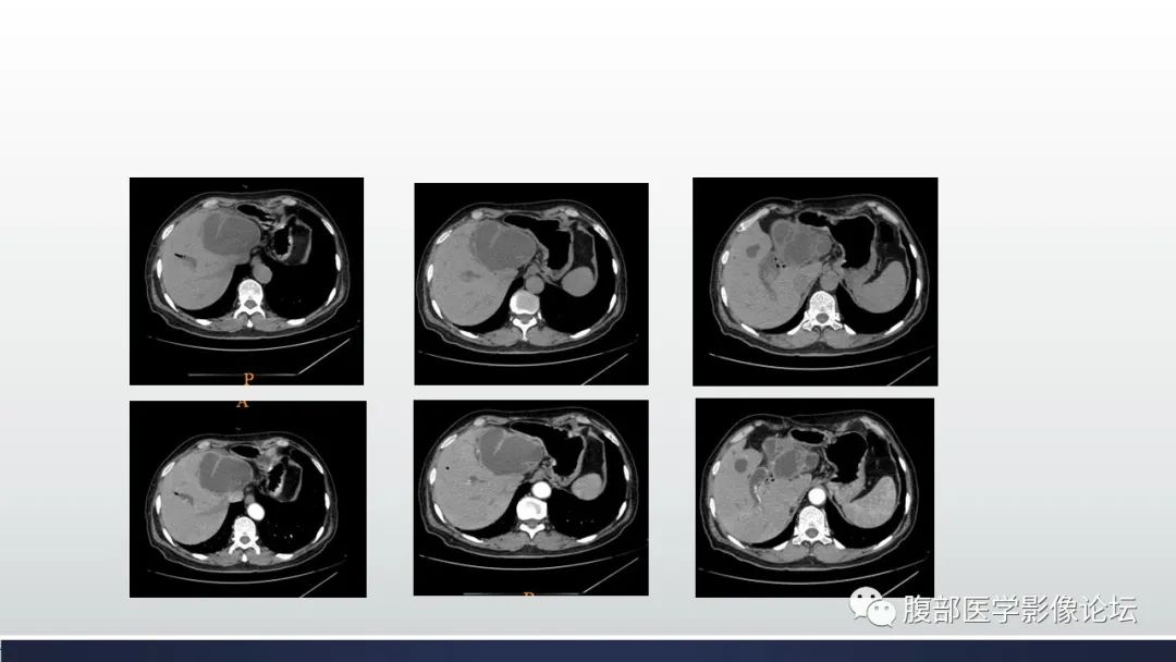 【病例】肝脏交界性粘液性囊腺瘤1例CT及MR影像-3