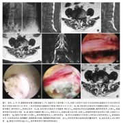 不典型老年极外侧腰椎间盘突出症合并椎管狭窄