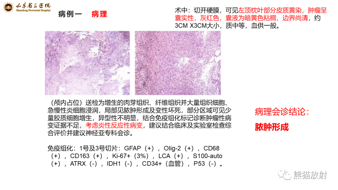 【病例】炎性肉芽肿并脓肿形成 & 成熟性囊性畸胎瘤-11