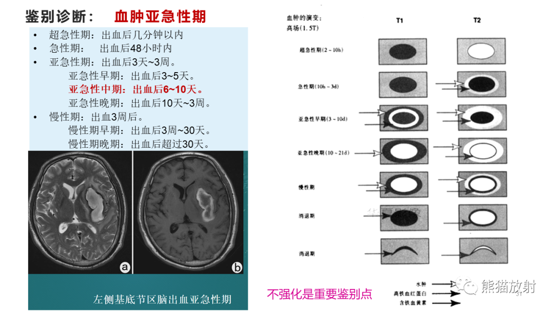 【病例】炎性肉芽肿并脓肿形成 & 成熟性囊性畸胎瘤-15