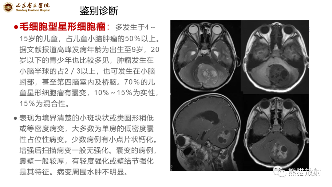 【病例】炎性肉芽肿并脓肿形成 & 成熟性囊性畸胎瘤-18