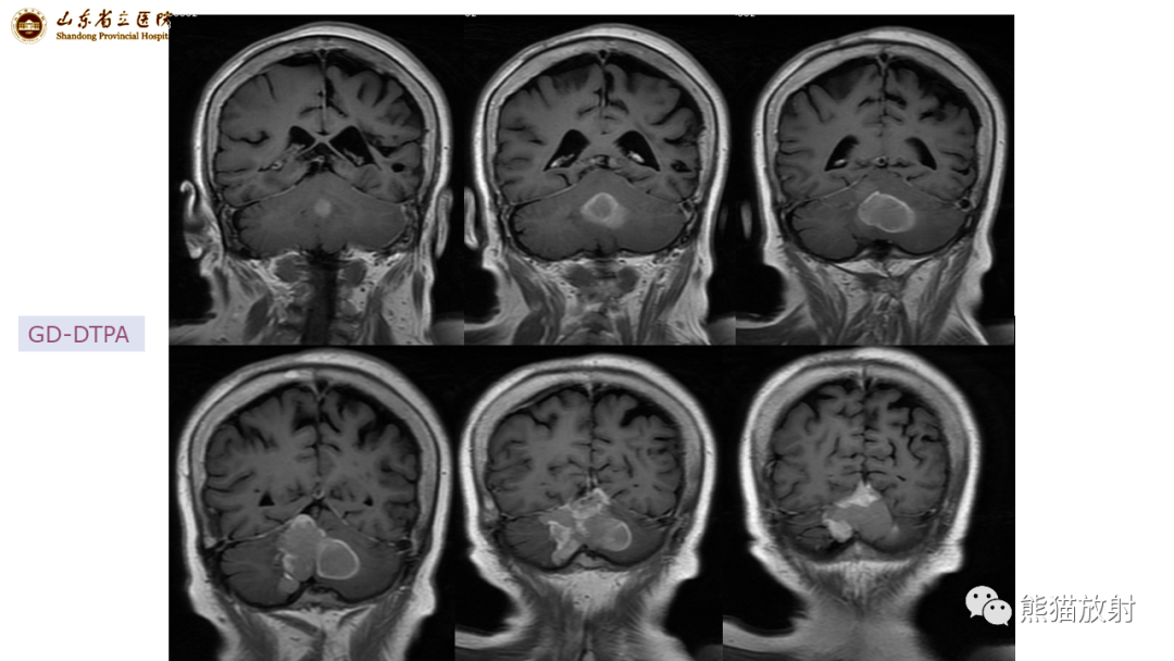 【病例】炎性肉芽肿并脓肿形成 & 成熟性囊性畸胎瘤-9