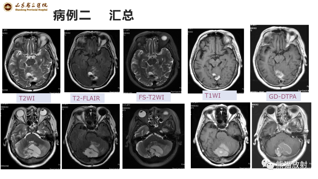 【病例】炎性肉芽肿并脓肿形成 & 成熟性囊性畸胎瘤-7