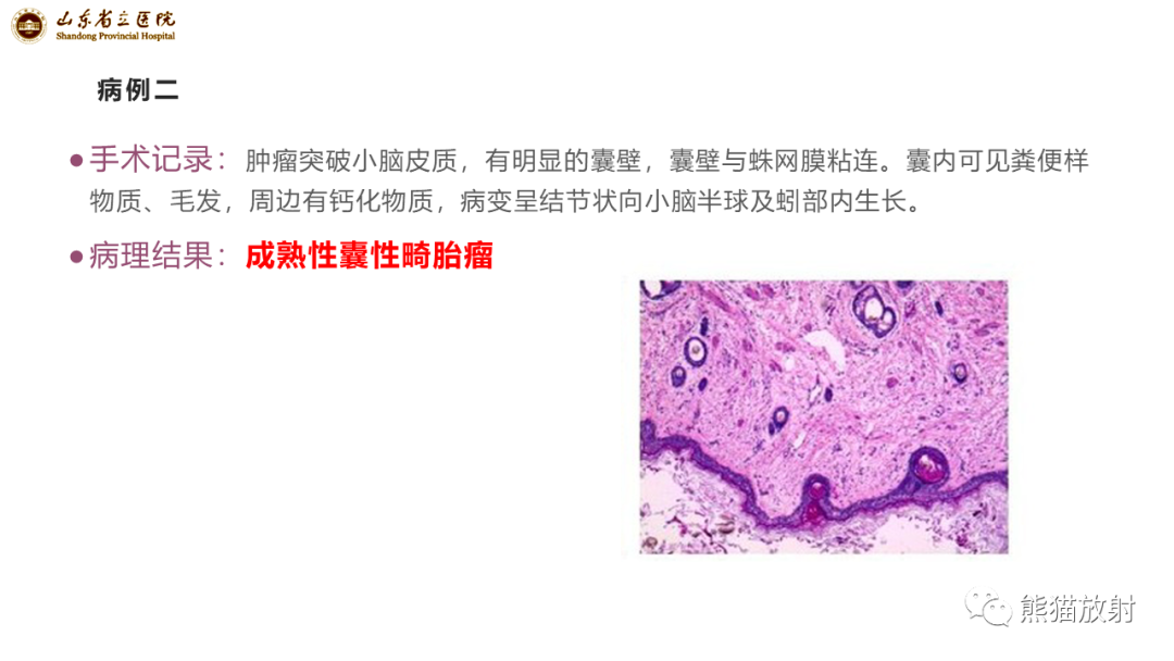 【病例】炎性肉芽肿并脓肿形成 & 成熟性囊性畸胎瘤-12