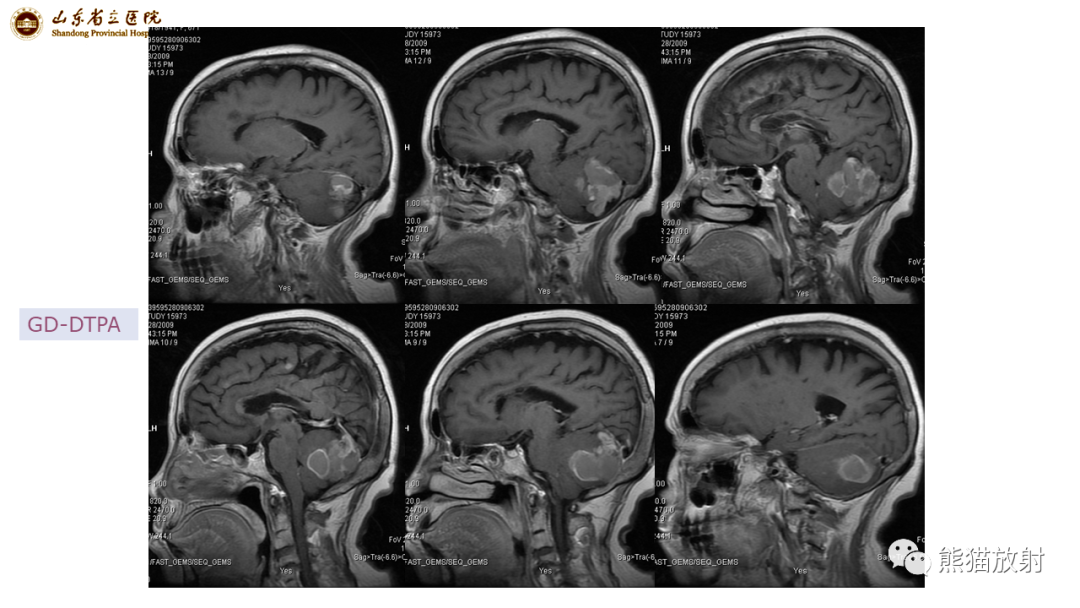 【病例】炎性肉芽肿并脓肿形成 & 成熟性囊性畸胎瘤-8