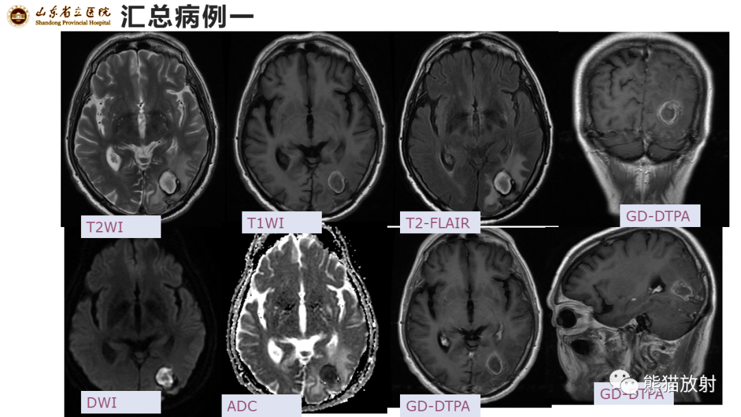 【病例】炎性肉芽肿并脓肿形成 & 成熟性囊性畸胎瘤-3