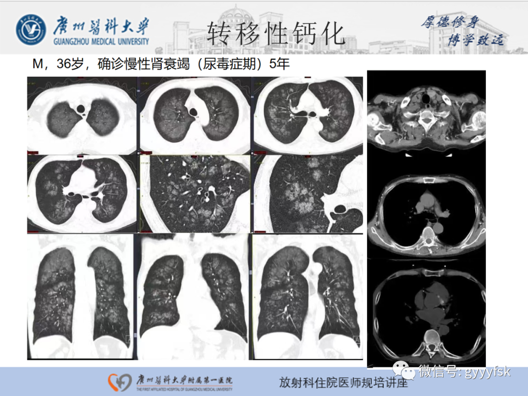 【PPT】肺泡微石症阅片指导-25