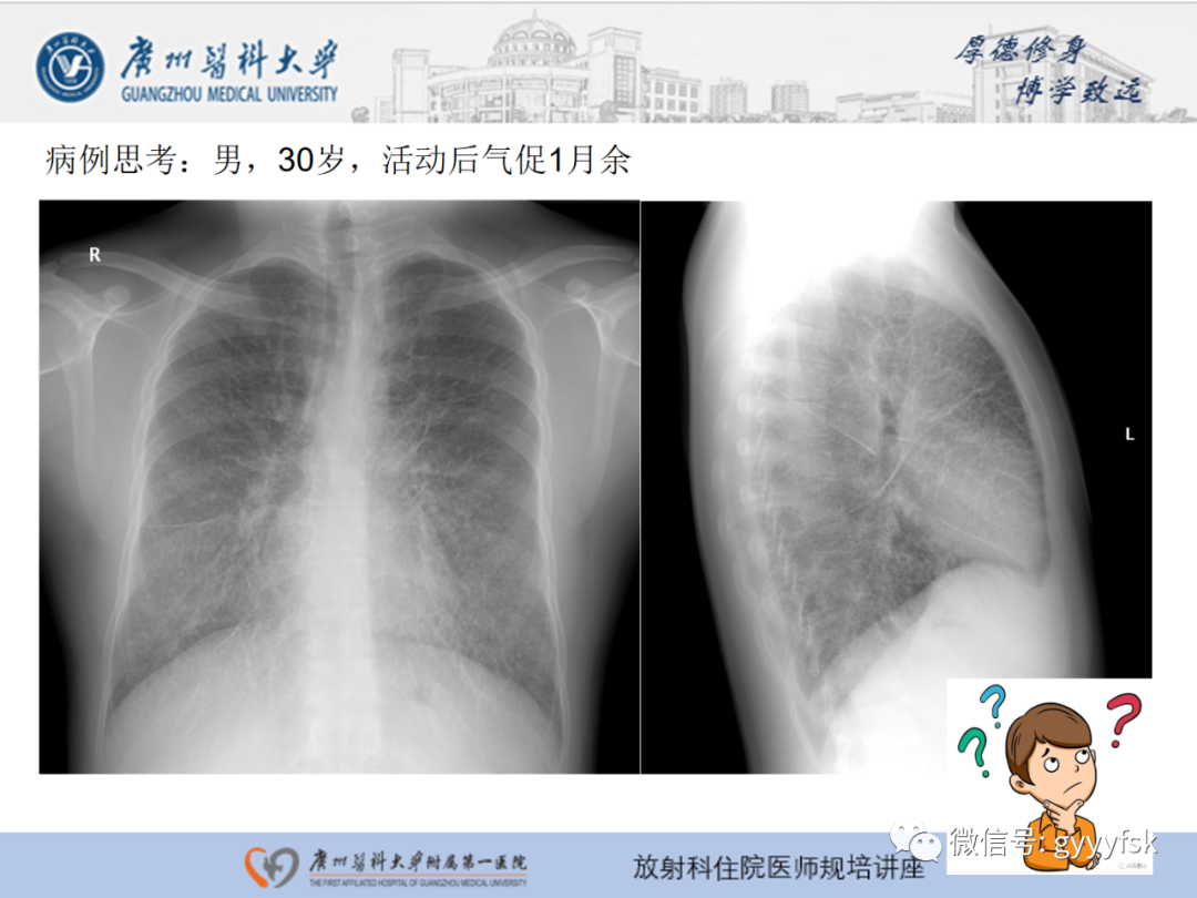 【PPT】肺泡微石症阅片指导-2