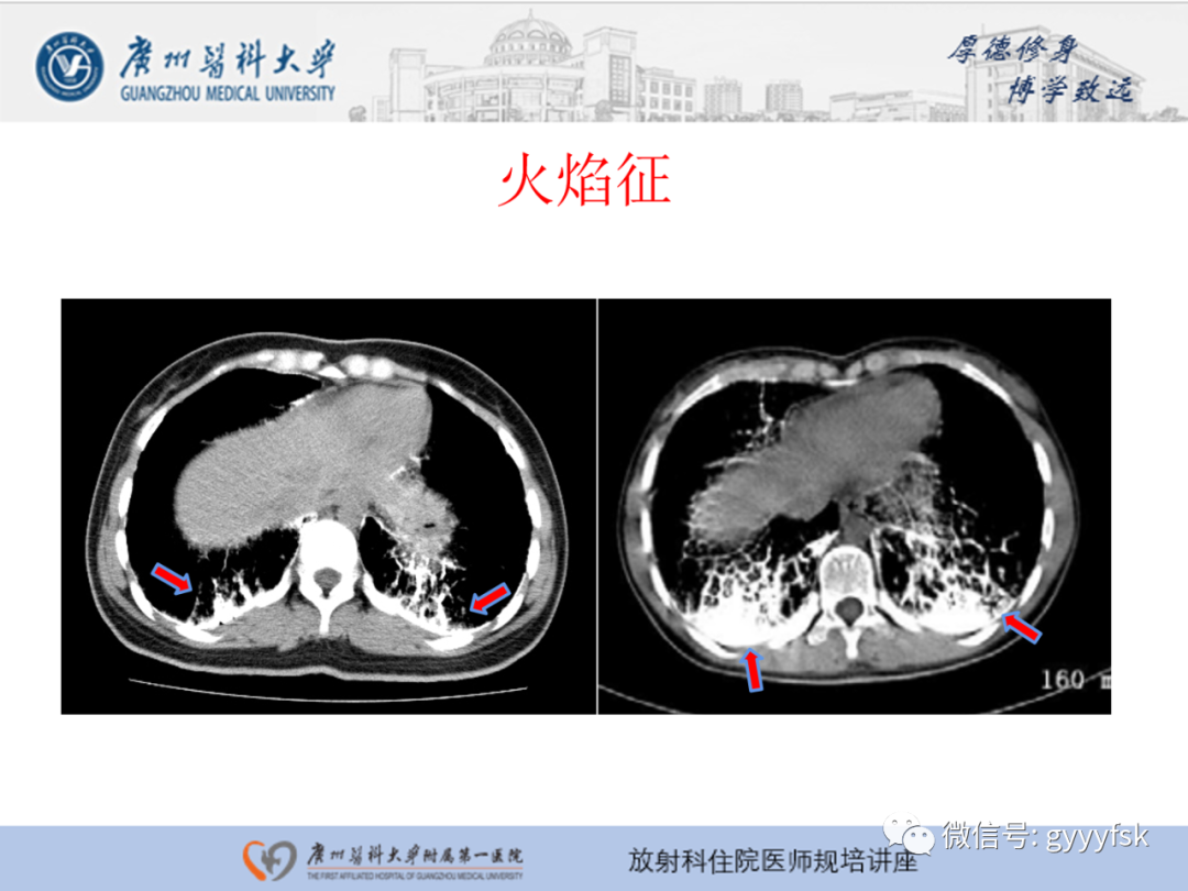 【PPT】肺泡微石症阅片指导-17