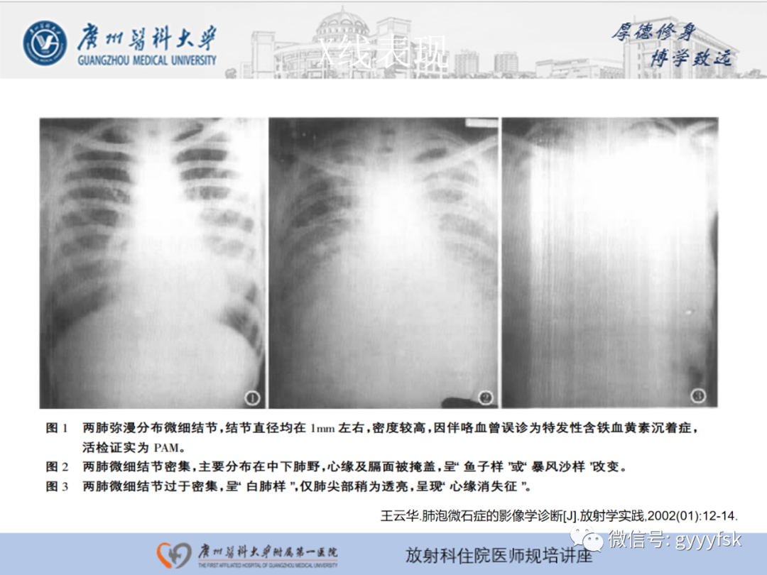 【PPT】肺泡微石症阅片指导-13