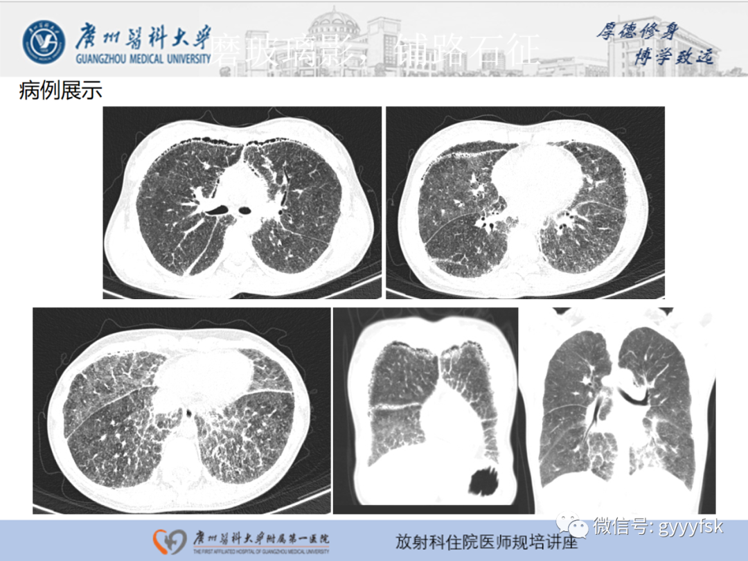 【PPT】肺泡微石症阅片指导-19
