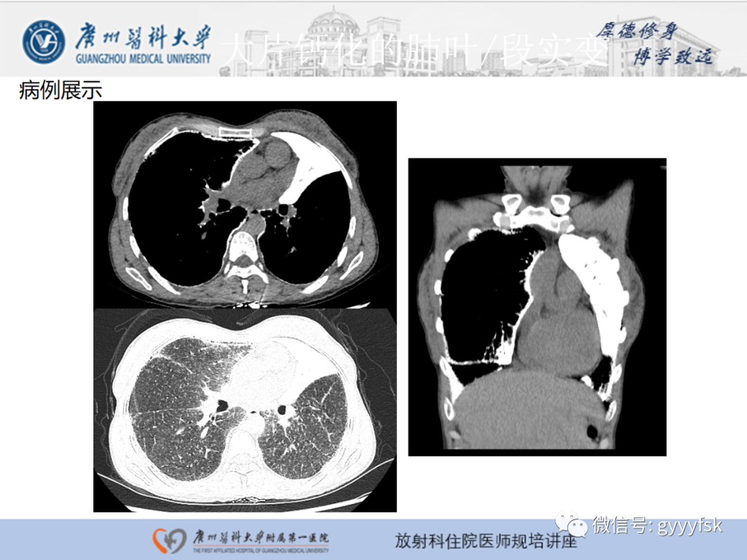 【PPT】肺泡微石症阅片指导-20